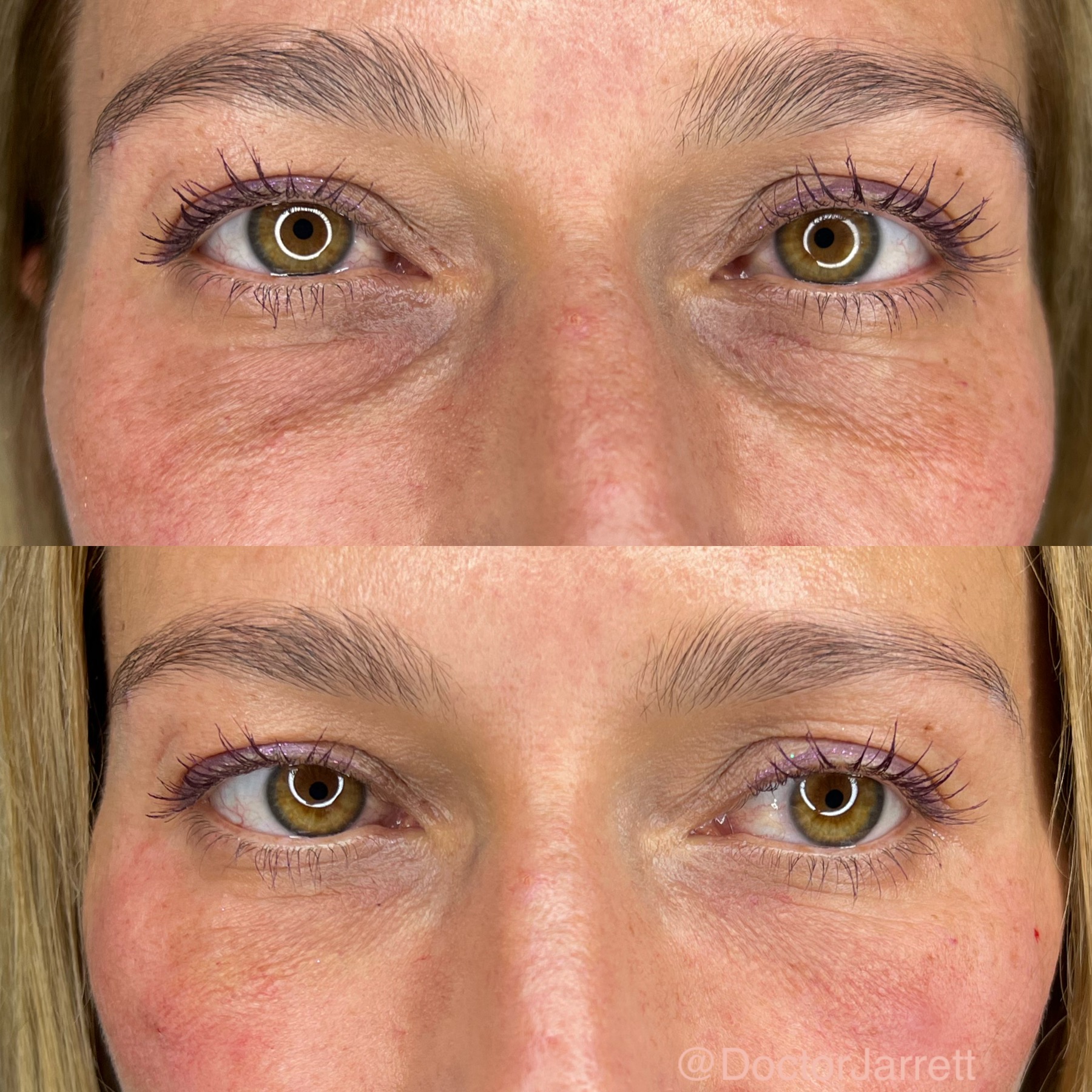 belotero before and after under eyes