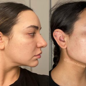 Jawline Contouring