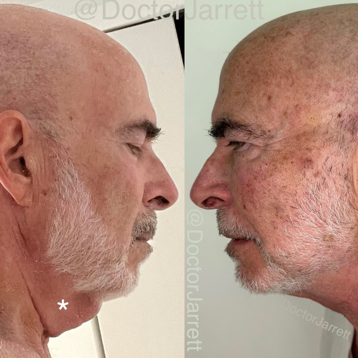 PDO Thread Lift Designer Aesthetics by Dr. Jarrett Schanzer Miami