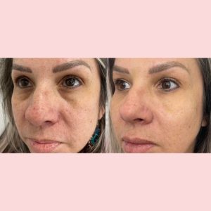 undereye filler miami
