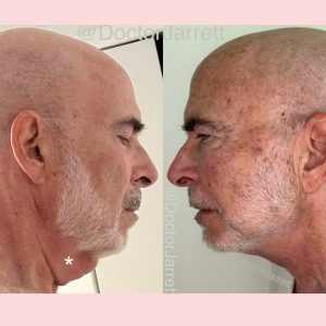 PDO thread lift miami
