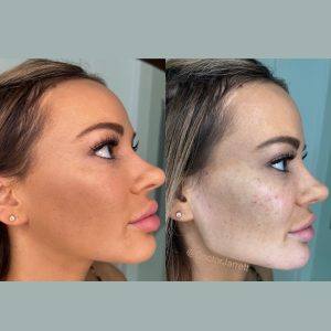 jawline filler facial balancing radiesse dermal fillers hyaluronic acid side profile jawline contouring