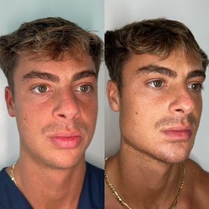 jawline filler facial balancing jawline contouring jawline enhancement radiesse restylane chin filler juvederm the bachelor golden ratio medspa side profile balancing facial balancing male enhancement top injector facial contouring chin implant