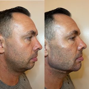 jawline filler chin filler male facial balancing male enhancement brotox nonsurgical chin implant radiesse dermal fillers double chin turkey neck