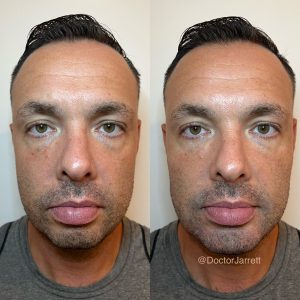 Chin Jawline Contouring