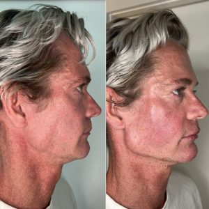 Chin Jawline Contouring