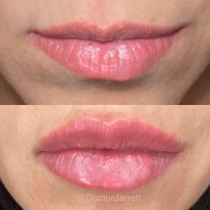 Lip filler Miami