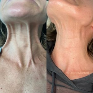 nefertiti necklift nonsurgical necklift jawline contouring platysmal bands neck bands turkey neck rejuvenation botox dysport xeomin letybo jeuveau daxxify botulinum toxin Neck Décolleté