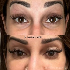 Under Eye Filler