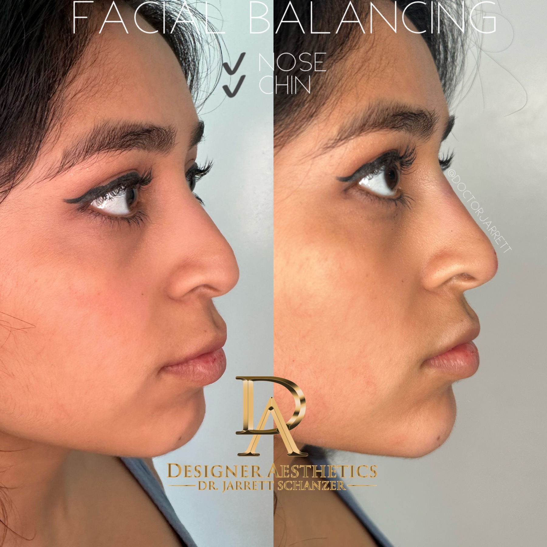 Nonsurgical Rhinoplasty nose nose job injector injecting fillers botox no surgery best nose job americas top 100 injector doctor miami new york brickell south beach soho miami beach med spa aesthetics beauty transformation injection liquid nose job