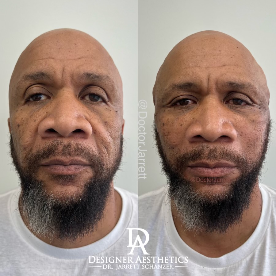 #pdo #thread #pdothreads #facelift #nonsurgical #transformation #beauty #antiaging #aesthetics #miami #newyork #miami injector #medspa #americatop100injector #newyorkinjector #perfection #beauty #injections #fillers #injectables #doctor