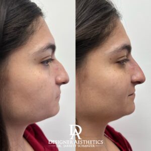 Nonsurgical Rhinoplasty nose nose job injector injecting fillers botox no surgery best nose job americas top 100 injector doctor miami new york brickell south beach soho miami beach med spa aesthetics beauty transformation injection liquid nose job