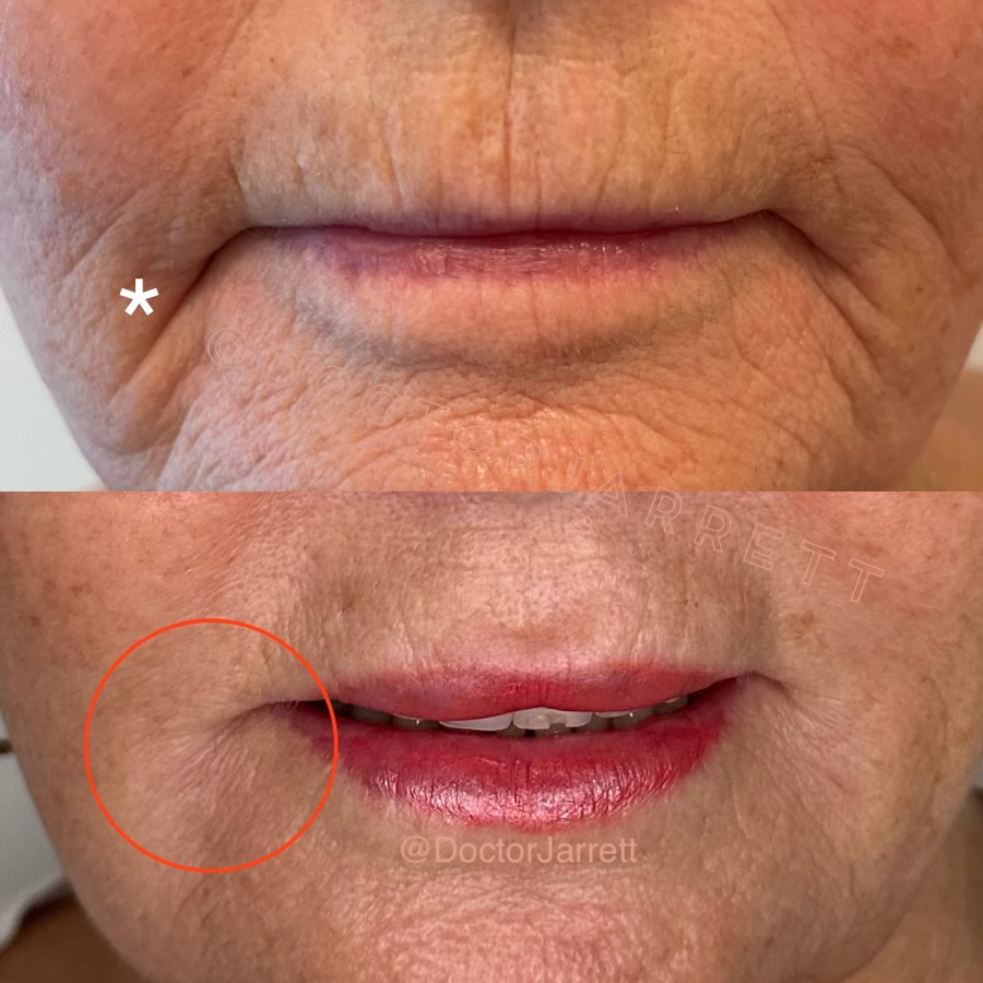 #lips #tfillers #lipfiller #lipaugmentation #juicy #plump #lip #injections #nonsurgical #transformation #beauty #antiaging #aesthetics #miami #newyork #miami injector #medspa #americatop100injector #newyorkinjector #perfection #beauty #injections #fillers #injectables #doctor