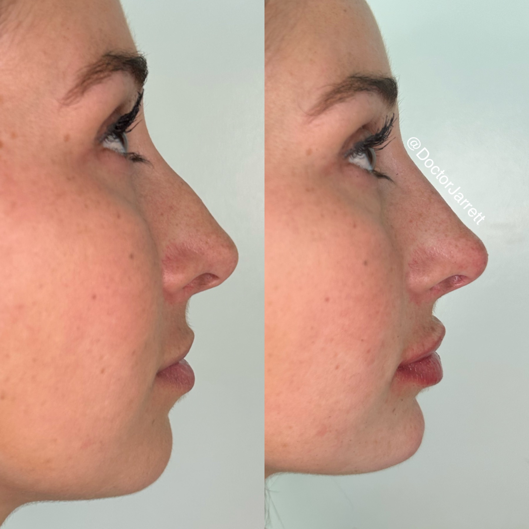 Nonsurgical Rhinoplasty nose nose job injector injecting fillers botox no surgery best nose job americas top 100 injector doctor miami new york brickell south beach soho miami beach med spa aesthetics beauty transformation injection liquid nose job