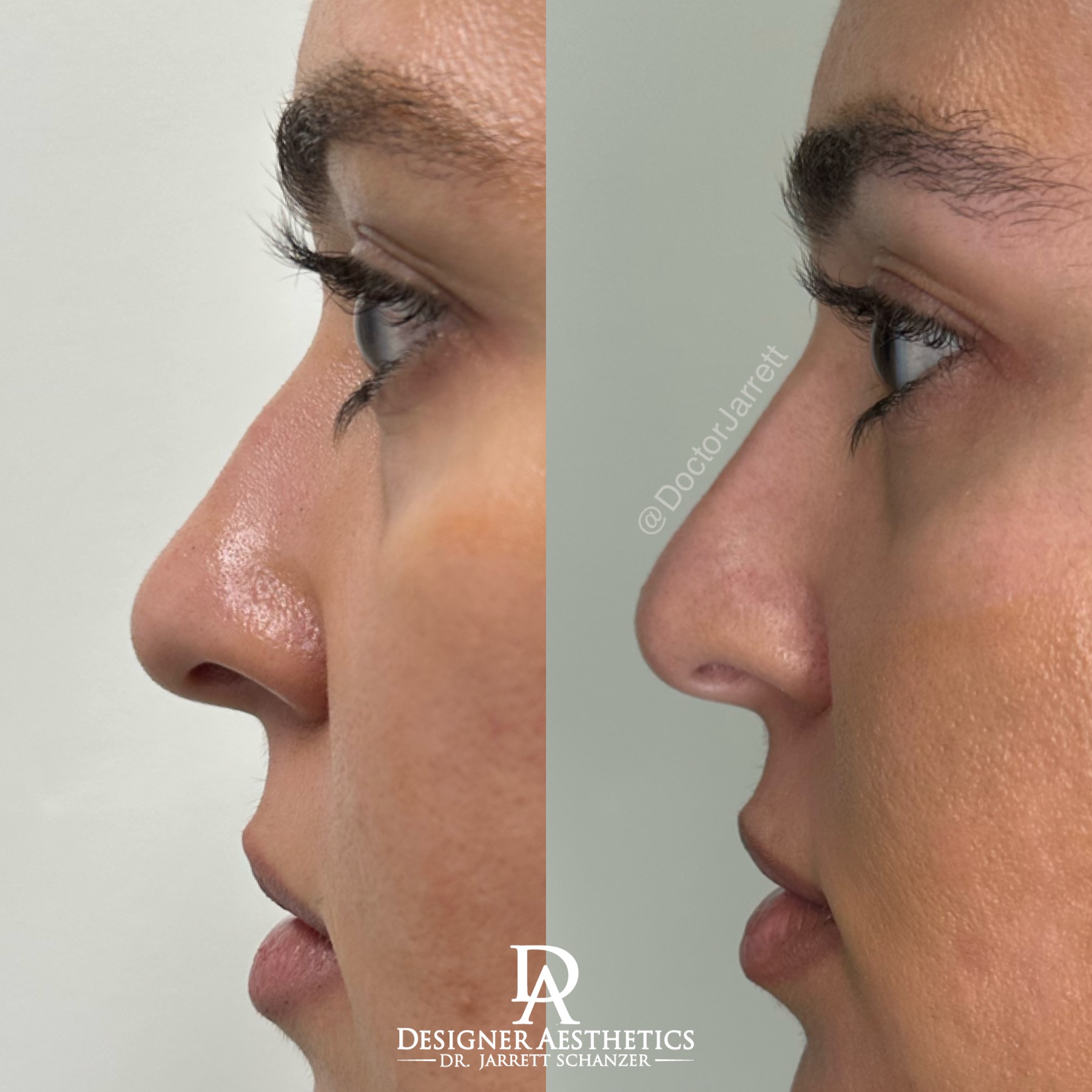 Nonsurgical Rhinoplastynose nose job injector injecting fillers botox no surgery best nose job americas top 100 injector doctor miami new york brickell south beach soho miami beach med spa aesthetics beauty transformation injection liquid nose job