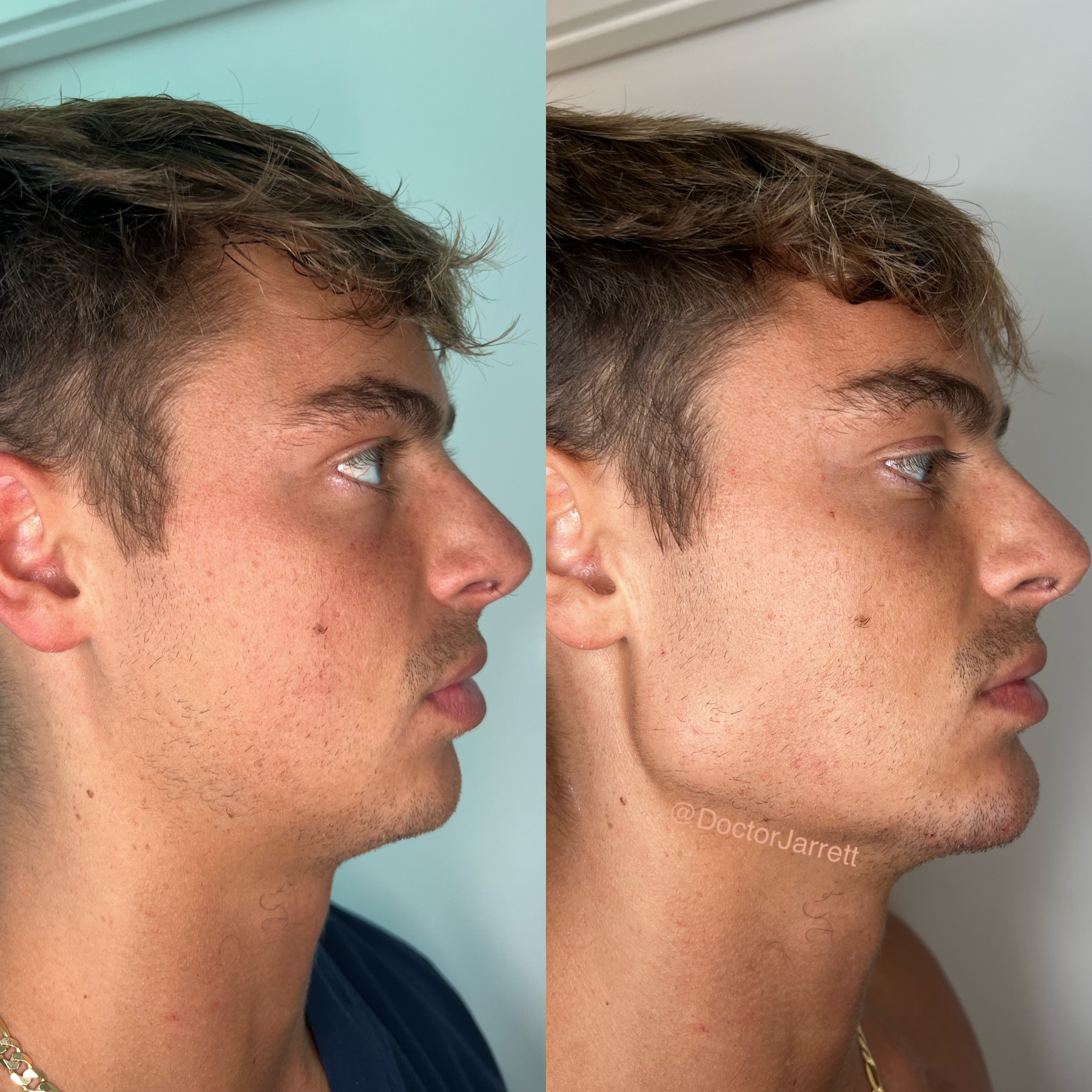 #jawline #fillers #jawlinecontour #aesthetics #miami #newyork #miami injector #medspa #americatop100injector #newyorkinjector #perfection #beauty #injections #fillers #injectables #doctor