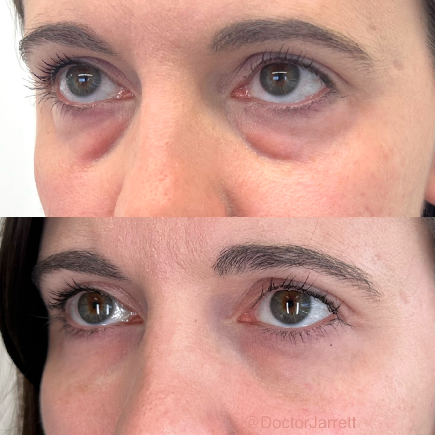under eyes under eye filler under eye bags undereyes undereyesfiller filler injections medspa doctor jarrett doctor miami new york injections injectable non surgical cosmetic beauty