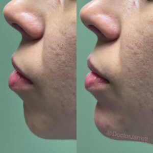 doctor jarrett Doctor Jarrett schanzer designer aesthetics miami new york doctor fillers injections botox thread chin youth balancing pdo thread lift botox neurotoxins aesthetics