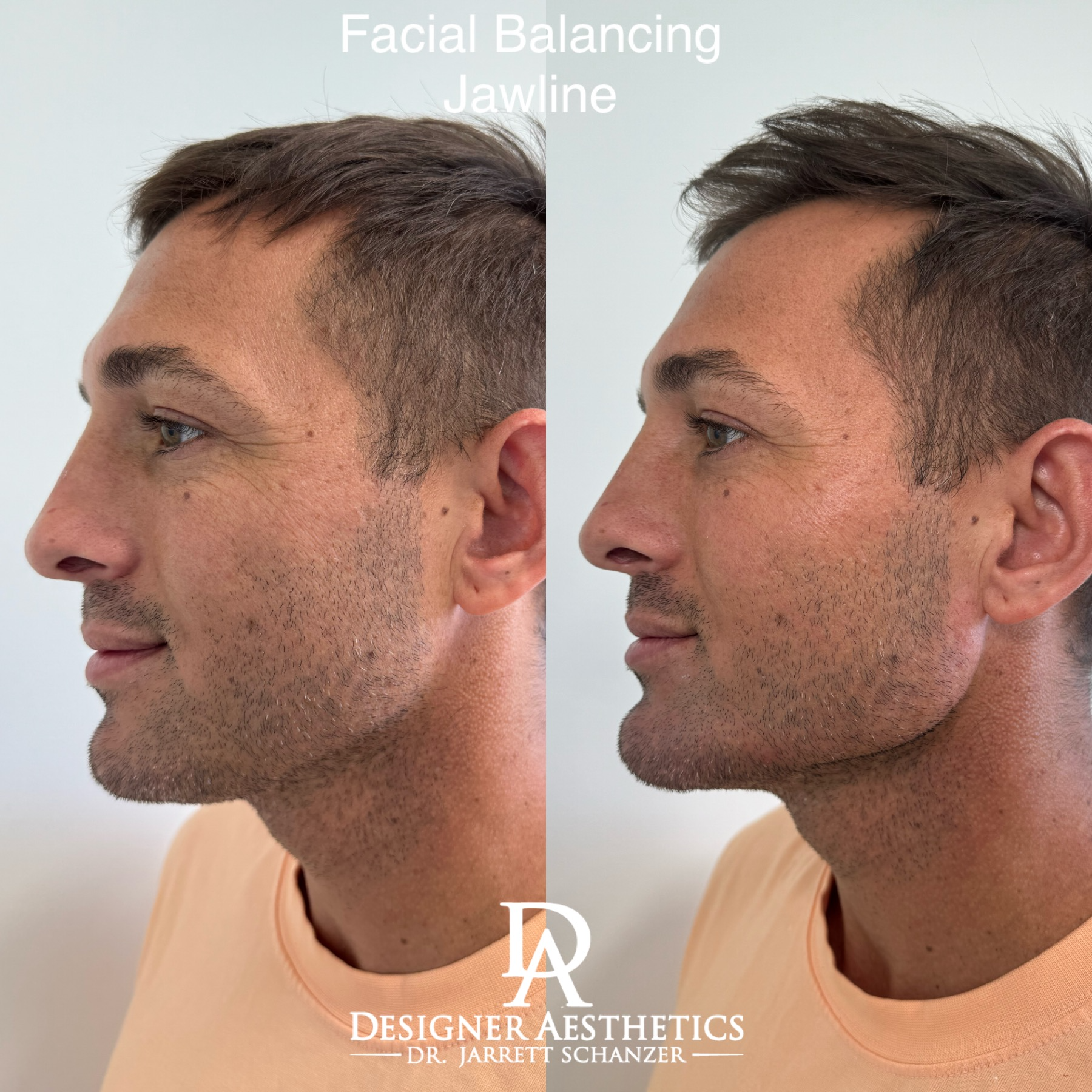 facial balancing doctor jarrett miami new york med spa doctor jarrett schanzer dr jarrett schanzer injector injecting top 100 injectors americas best fillers botox threads perfection facial balancing beauty jawline perfect