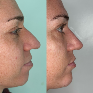 nose miami non surgical nose job liquid rhinoplasty nose filler no downtime filler injections miami new york doctor jarrett schanzer americas best beauty nose bump