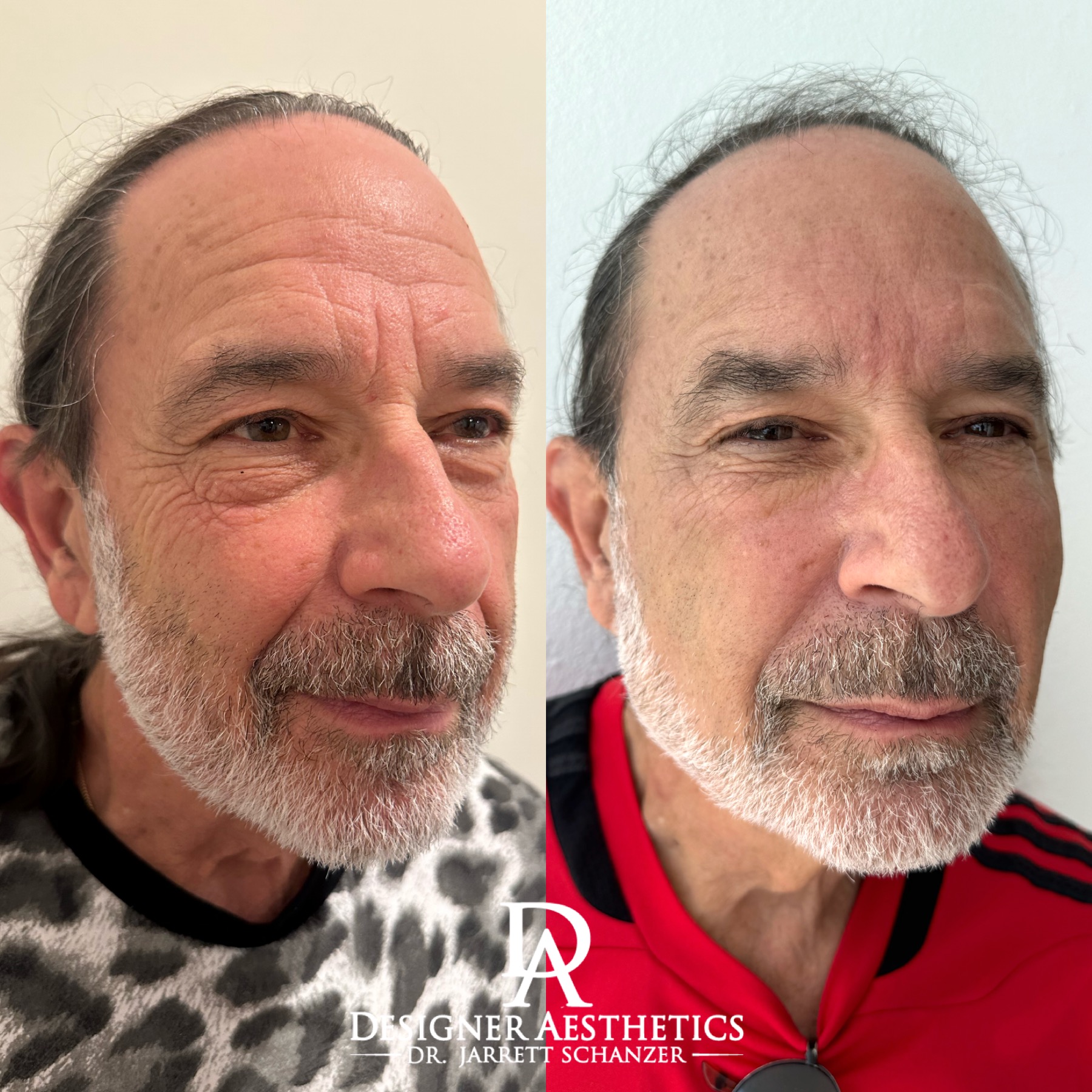 Facial Balancing Miami New york Doctor medspa aesthetics injections jarrett Schanzer