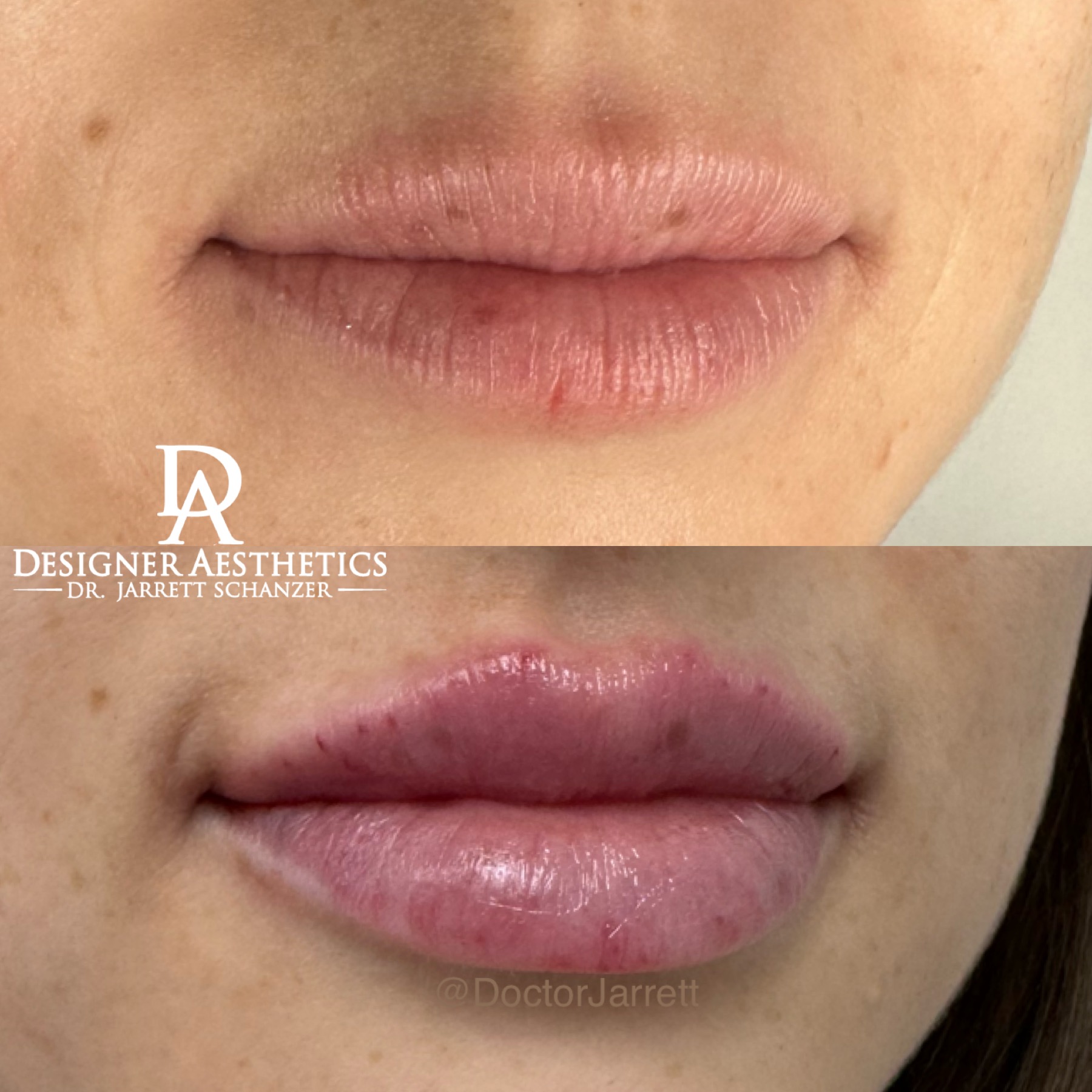 Lips Miami New york injections filler lip flip tox lips kissable americas best doctor jarrett schanzer perfect lips perfect smile perfection