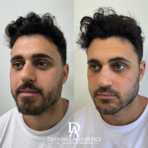 Jawline Contour Miami New york injections filler lip flip tox lips kissable americas best doctor jarrett schanzer perfect lips perfect jawline perfection