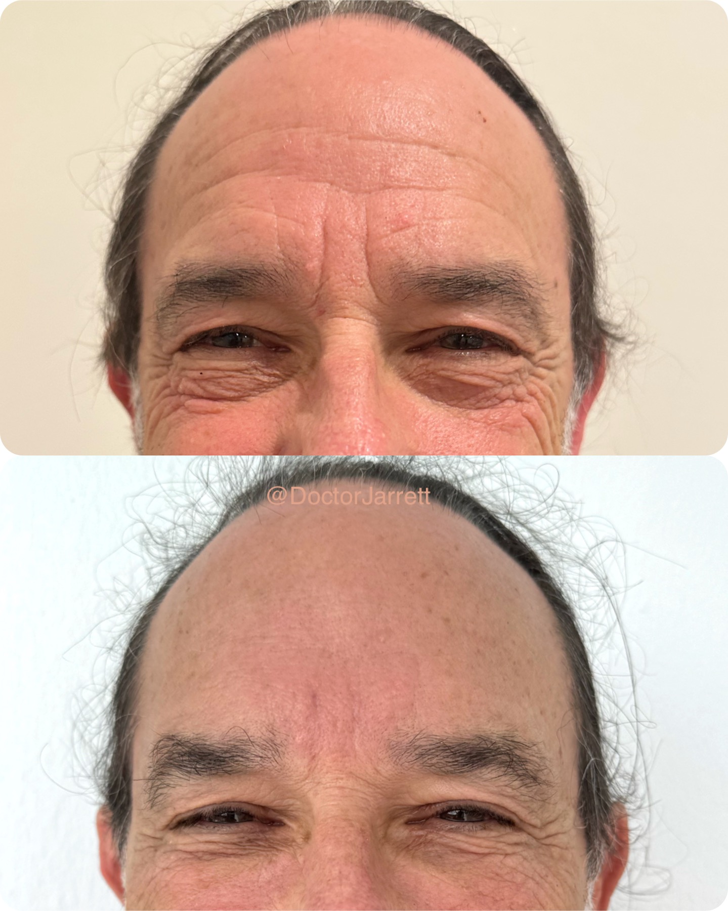 Forehead Filler Miami New York Med Spa Doctor Injecting Fillers Forehead Wrinkles Lines Aesthetics